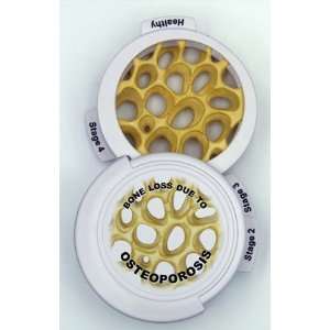 Osteoporosis 4 piece Hinged Osteoporosis Disk Set  