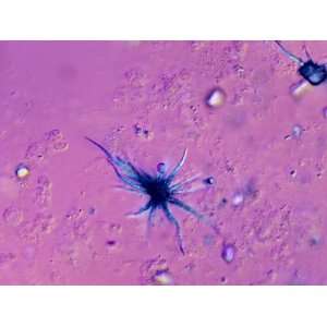  Urine with Ammonium Biurate Crystals, Unstained, Dic View 